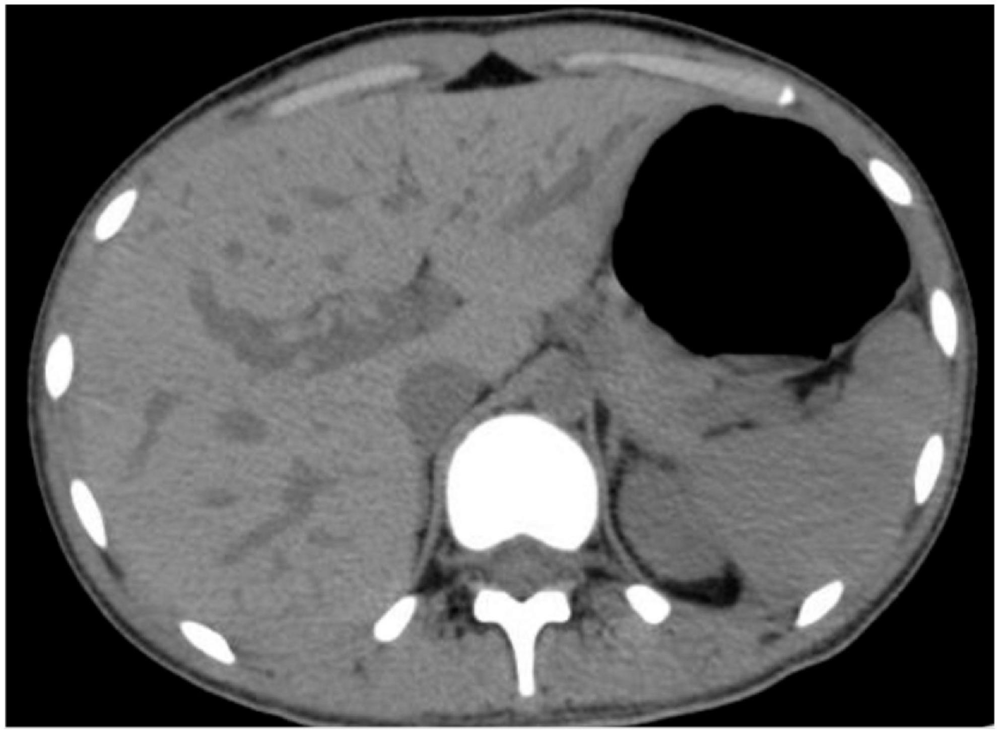 Case report: Recurrent hemobilia due to hepatic artery pseudoaneurysm mimicking gastrointestinal tract bleeding